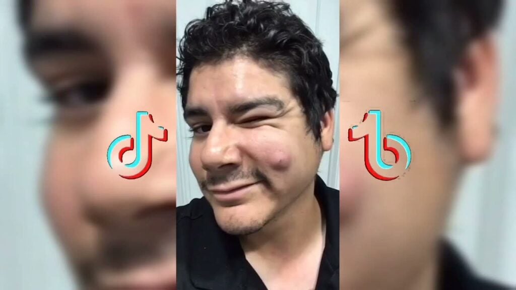 Pimple Popping Compilation 1