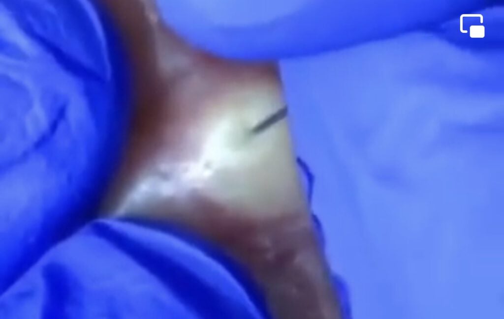 Two Dermatologists React to Cyst 1 Two Dermatologists React to Cyst 1
