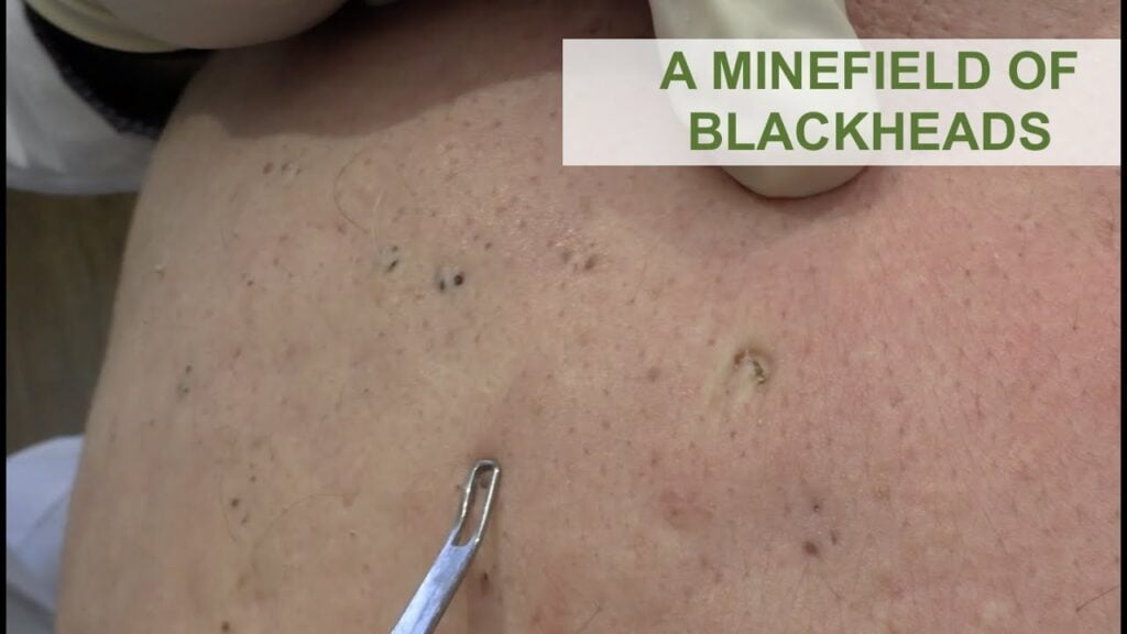 All the Blackheads 1