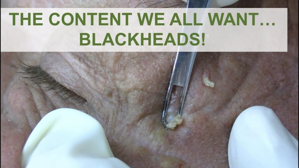 Blackheads from Sun Exposure 1