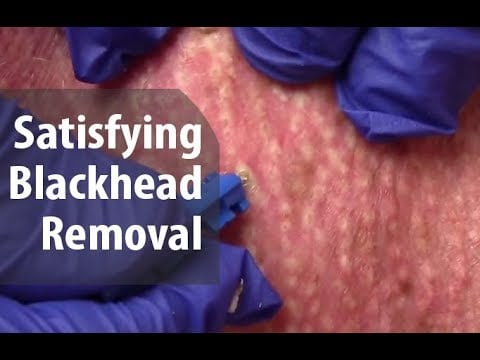Blackheads with Dr. Derm 2 Blackheads with Dr. Derm 1