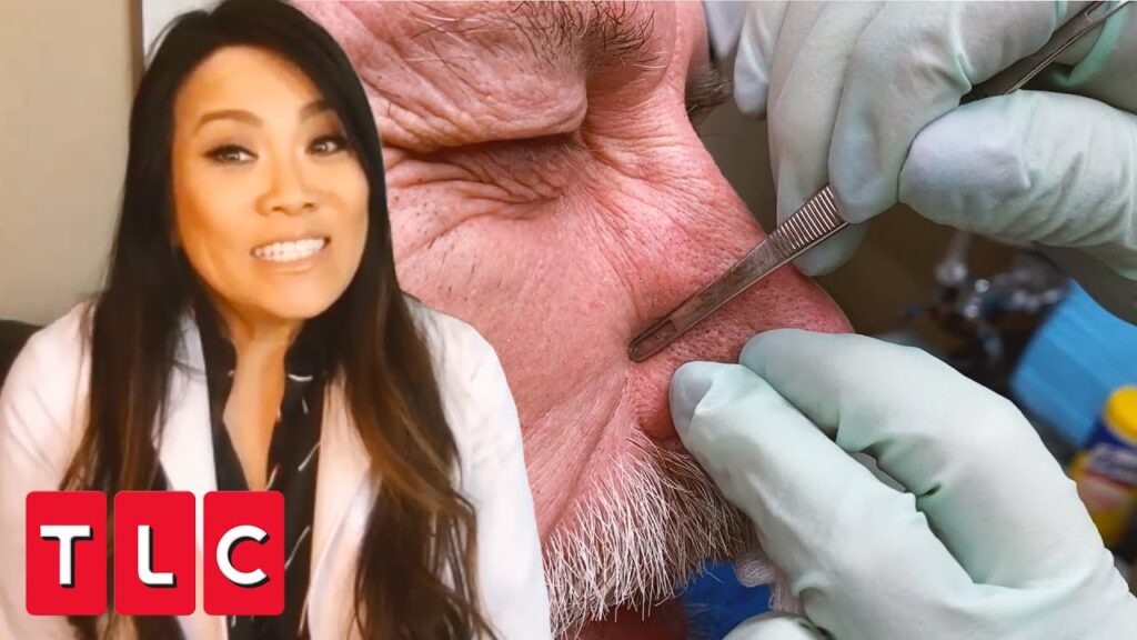 Dr. Pimple Popper Blackheads 1