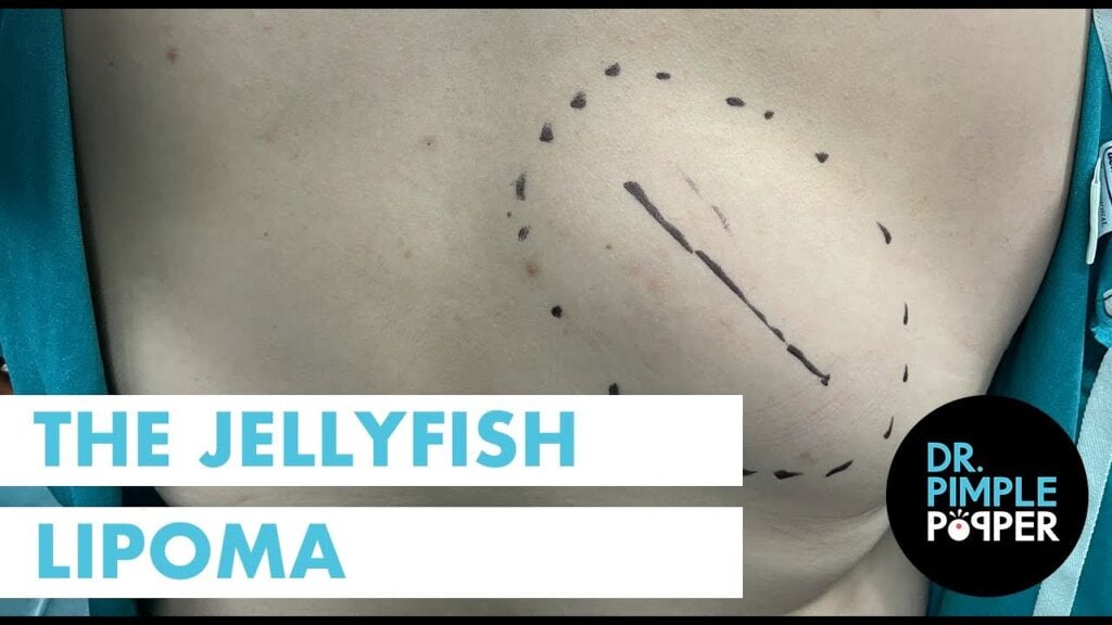 Massive Lipoma 1