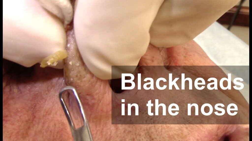 Nose Blackhead Extractions 1