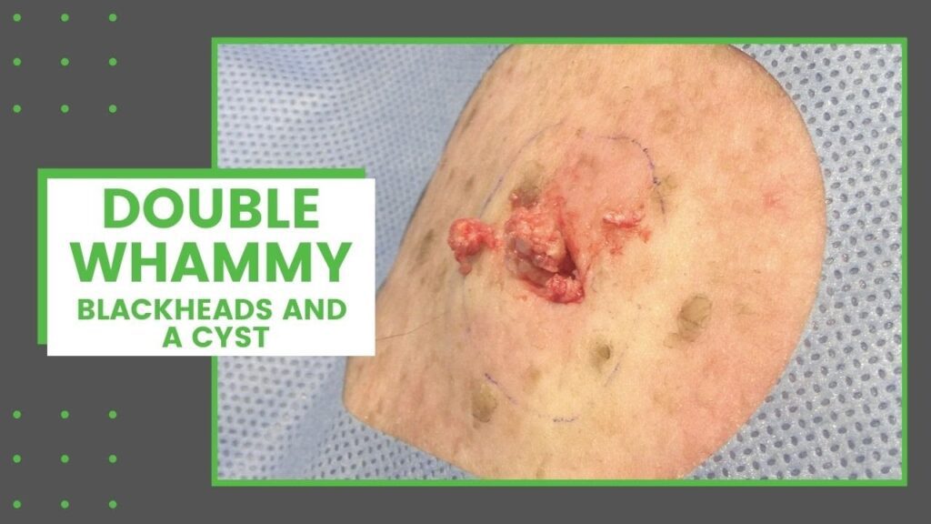 Blackheads and a Cyst 1