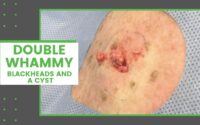 Blackheads and a Cyst 3 Blackheads and a Cyst 3
