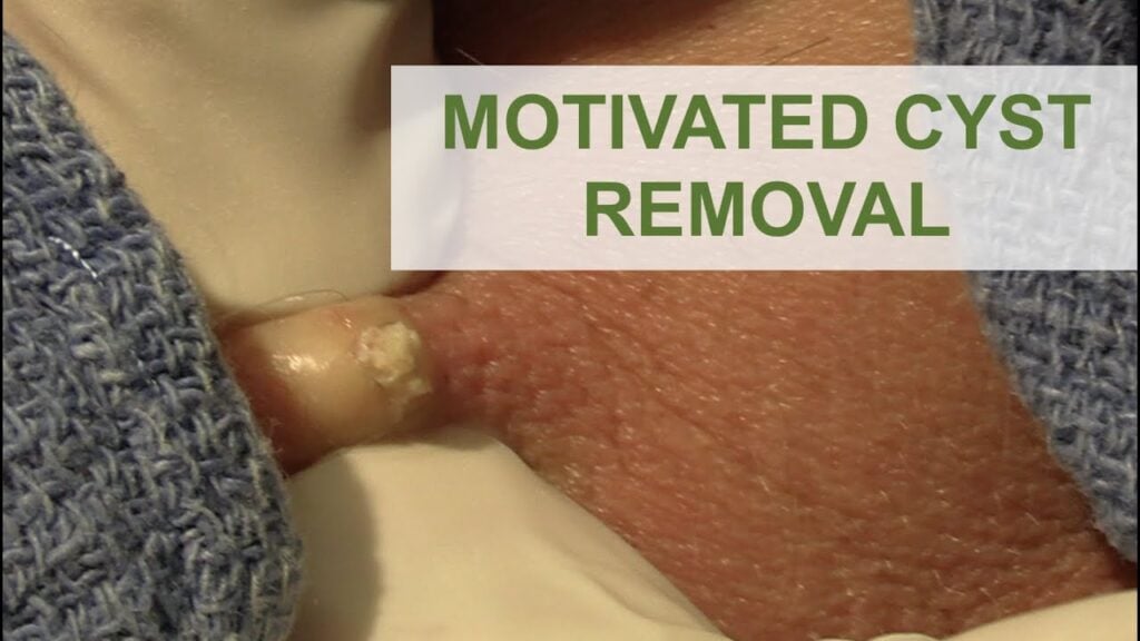 Cyst Looks can be Deceiving 1