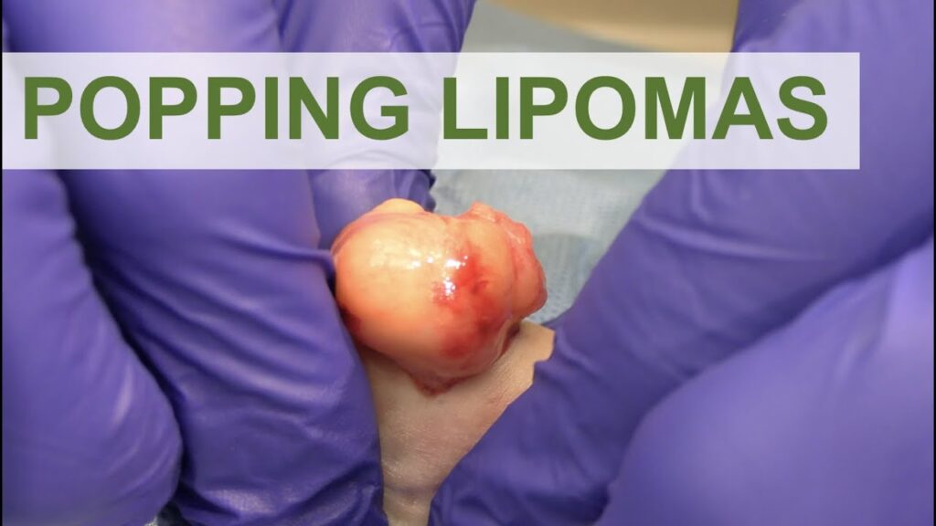 Lipoma Popping 2 Lipoma Popping 1