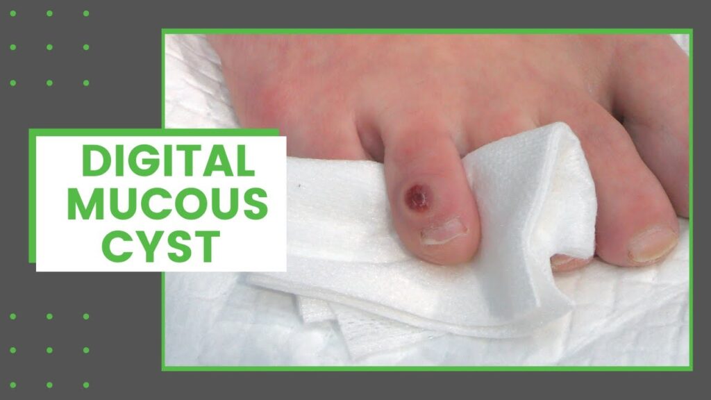 Mucous Cyst 1