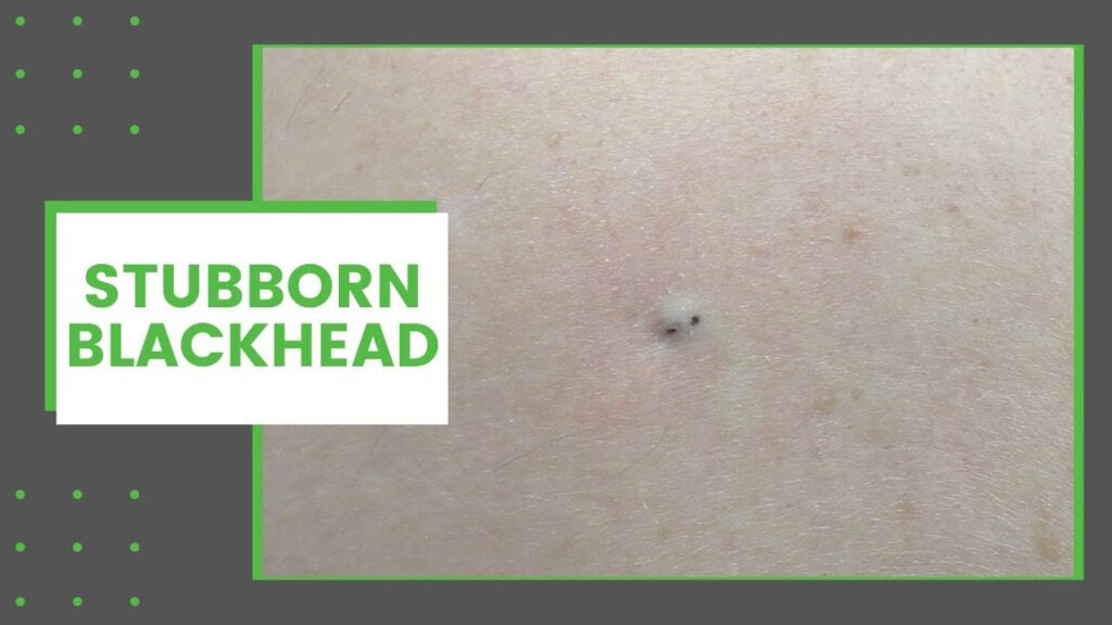 This Blackhead is Stubborn 2 This Blackhead is Stubborn 1