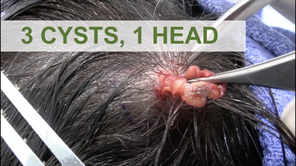 Triple Header Cyst 1