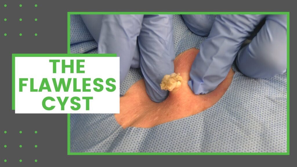 A Flawless Cyst 1