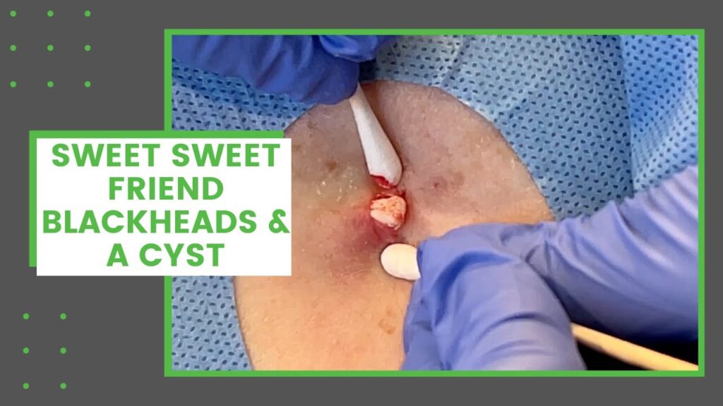 Blackheads and Cyst 1