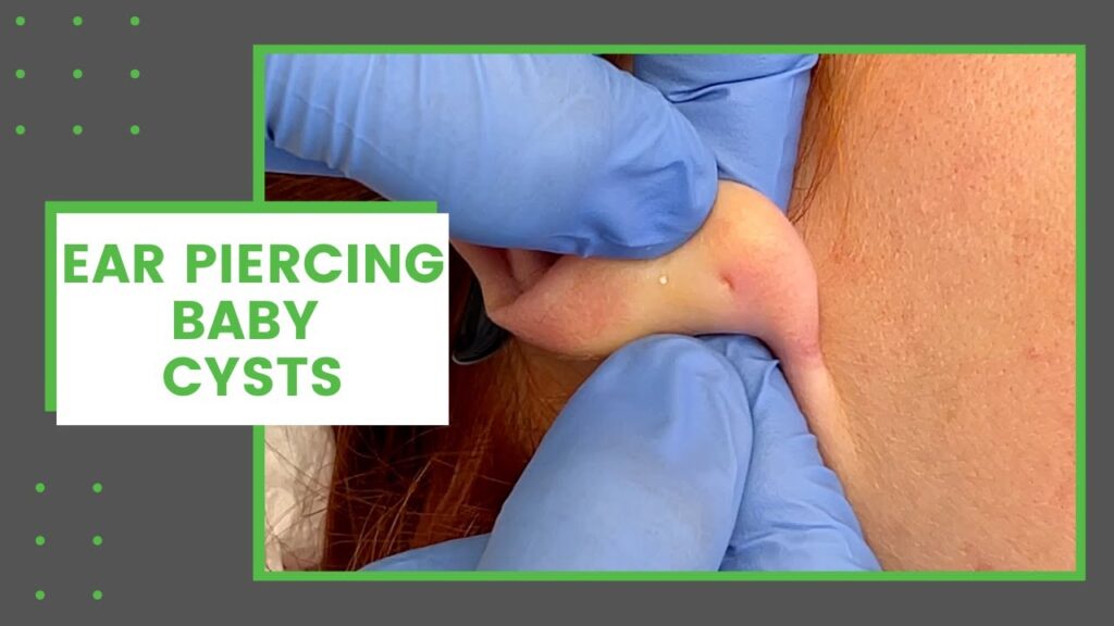 Cysts - Ear Piercing 1