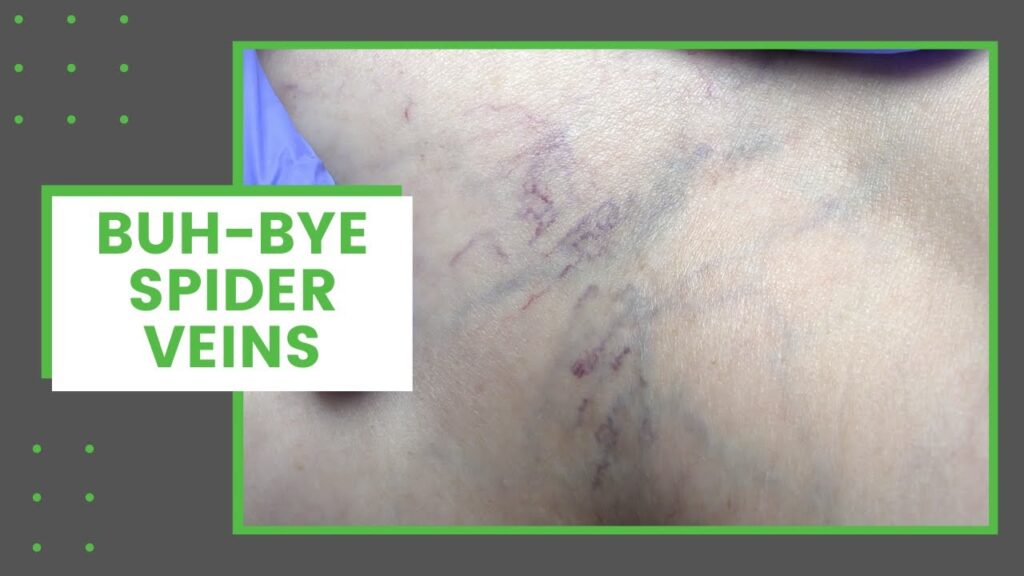 Spider Veins 1