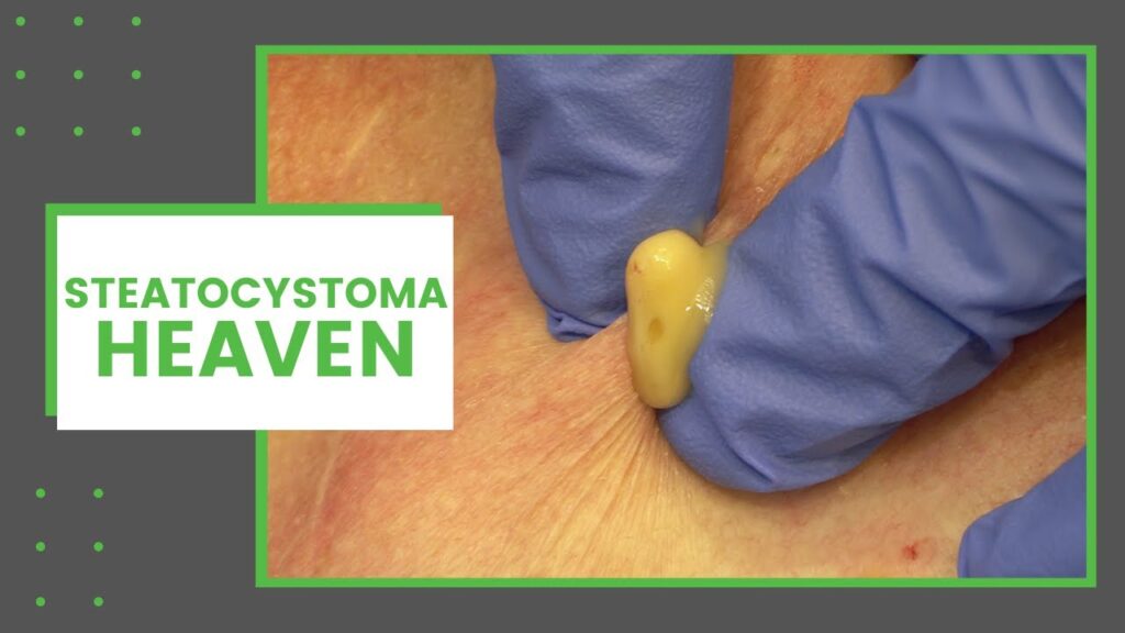 Steatocystoma - Dr Derm 2 Steatocystoma - Dr Derm 1