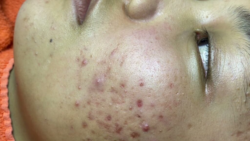 Acne Treatment 1