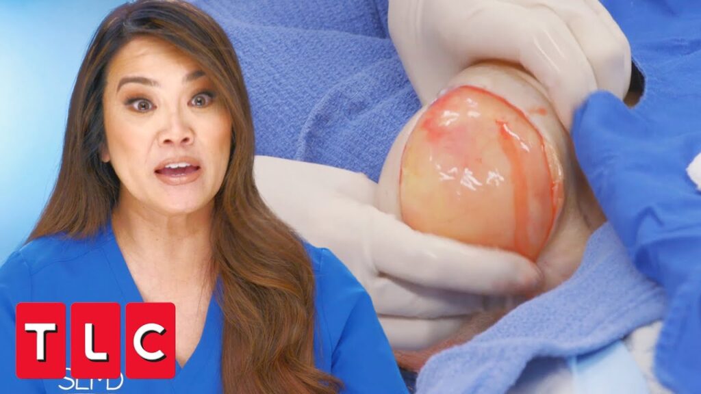 Bad Lipoma 1