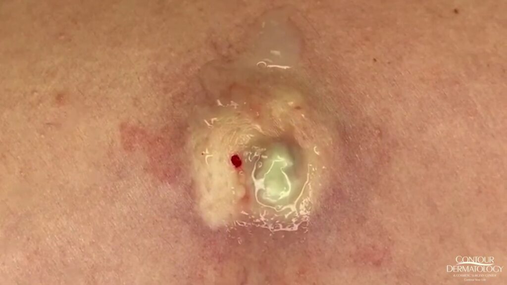 Cyst Extraction and Squeeze 1