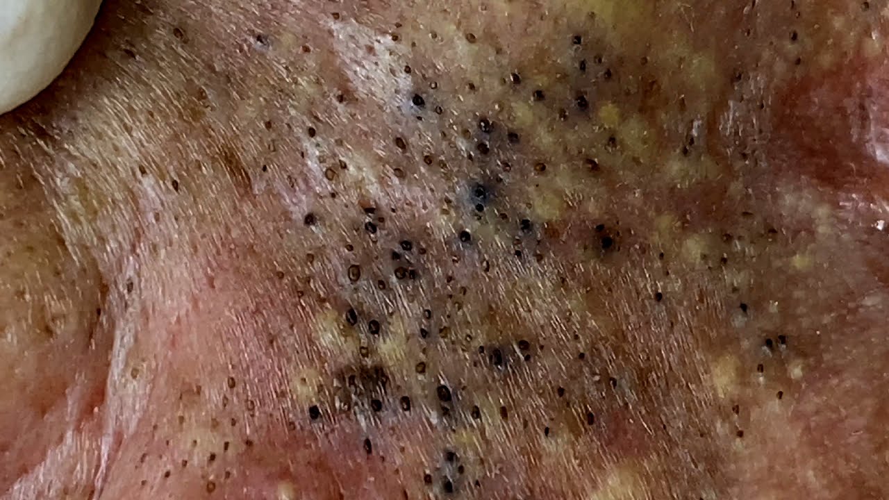 Pimple Popping Videos - Biggest Zits & Blackheads Popped