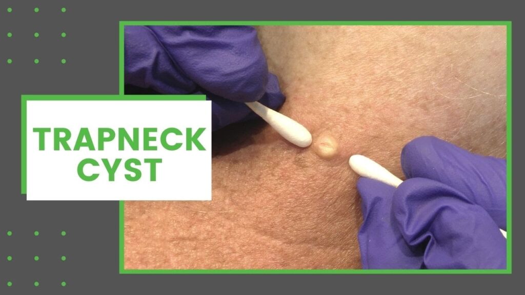 Neck Cyst 2 Neck Cyst 1