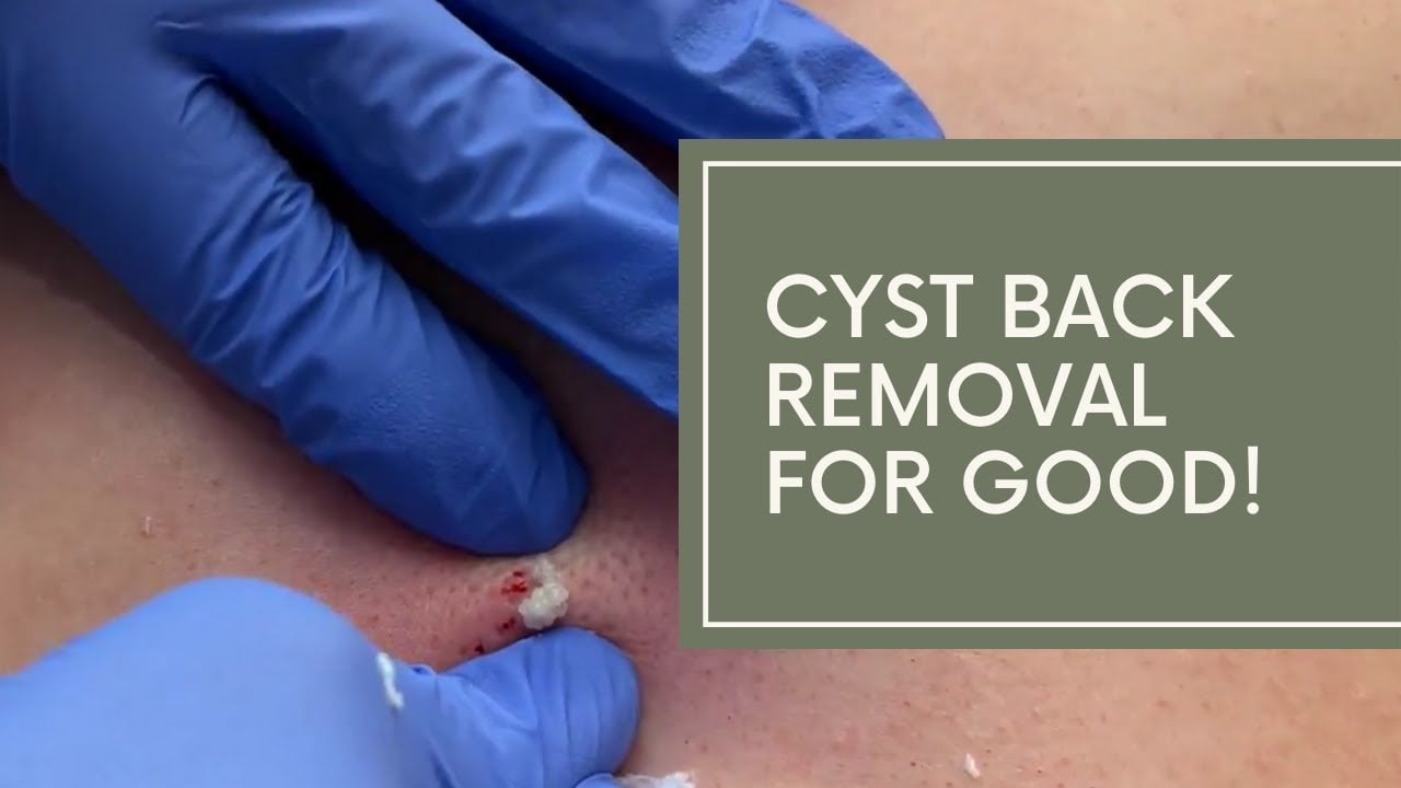 Back Cyst - Doctor Derm - Pop That Zit - Since 2006!