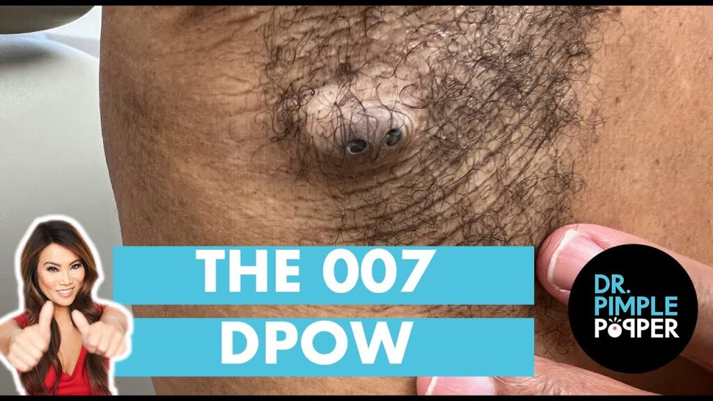 DPOW - Dr Pimple Popper 1