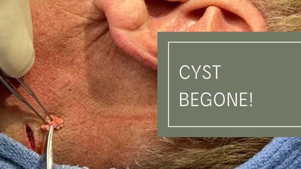 Dr Derm and a Cyst 2 Dr Derm and a Cyst 1