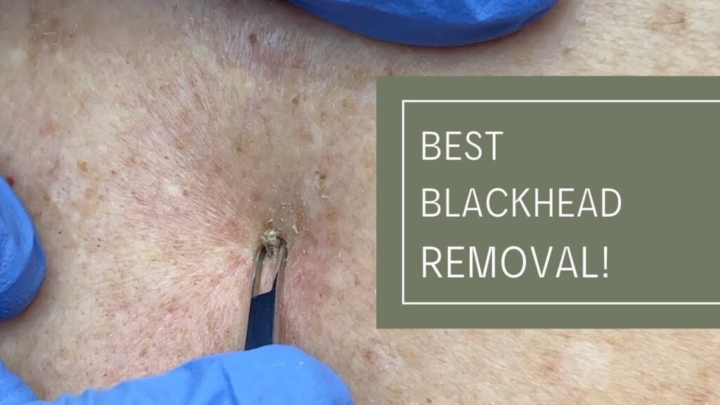 Dr Derm - Blackhead Removal 2 Dr Derm - Blackhead Removal 1