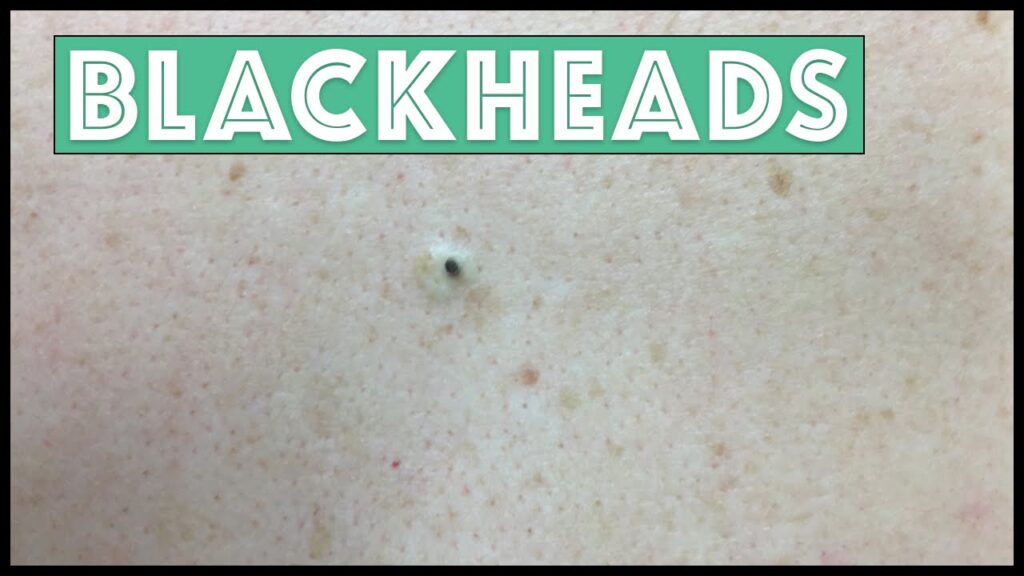 Dr Pimple Popper Blackheads 1