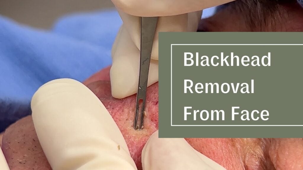 Face Blackheads 1