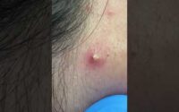 Littlest Pimple Pop 2 Littlest Pimple Pop 2