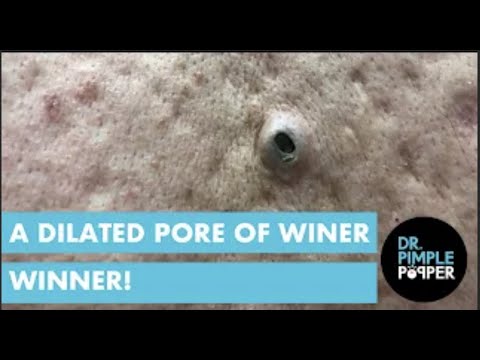 Pore of Winer Winner! 1