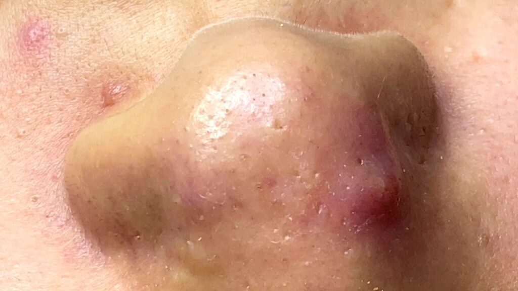 Relaxing Pimple Extractions 1