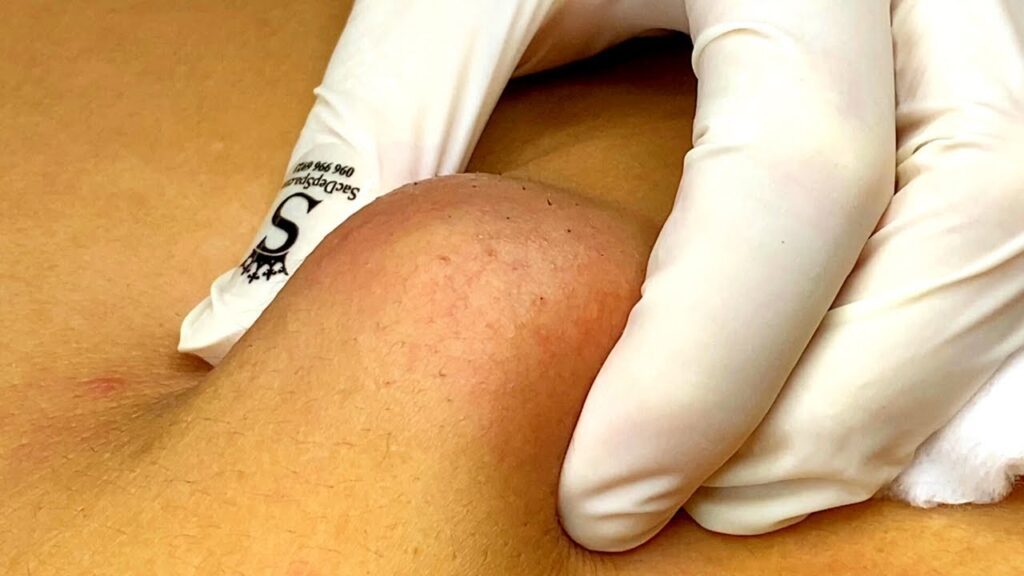 The Cyst That Never Ends 1