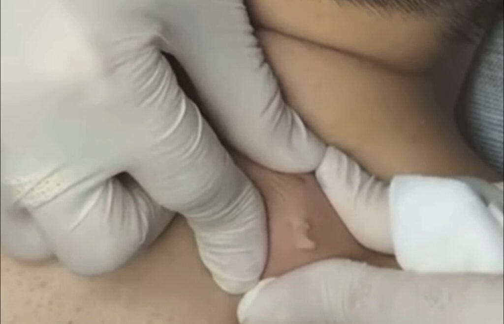Chunky Cyst Pop 1