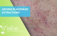 George’s Blackheads 1 George’s Blackheads 1