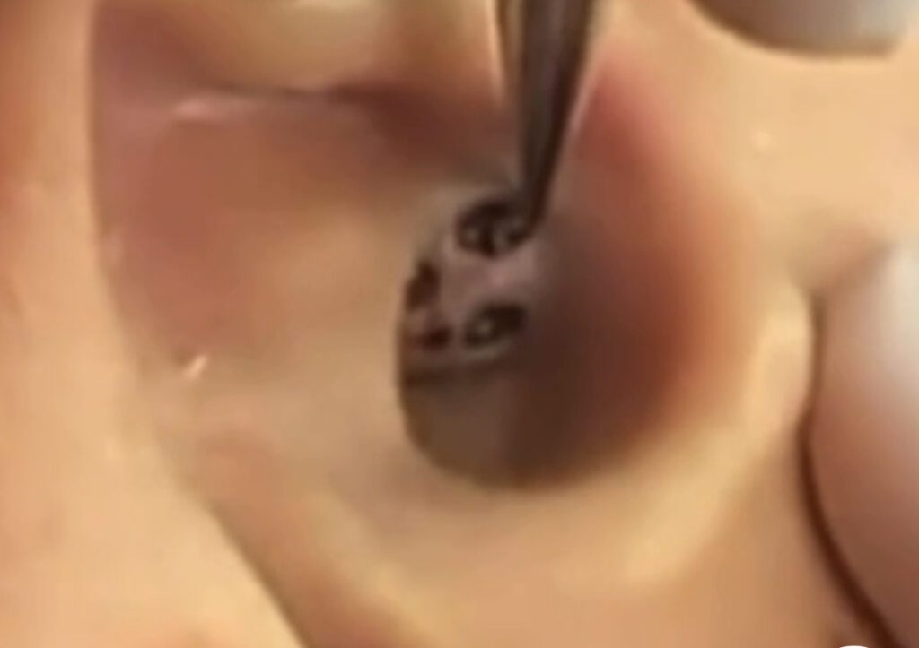 Blackheads Digging 1