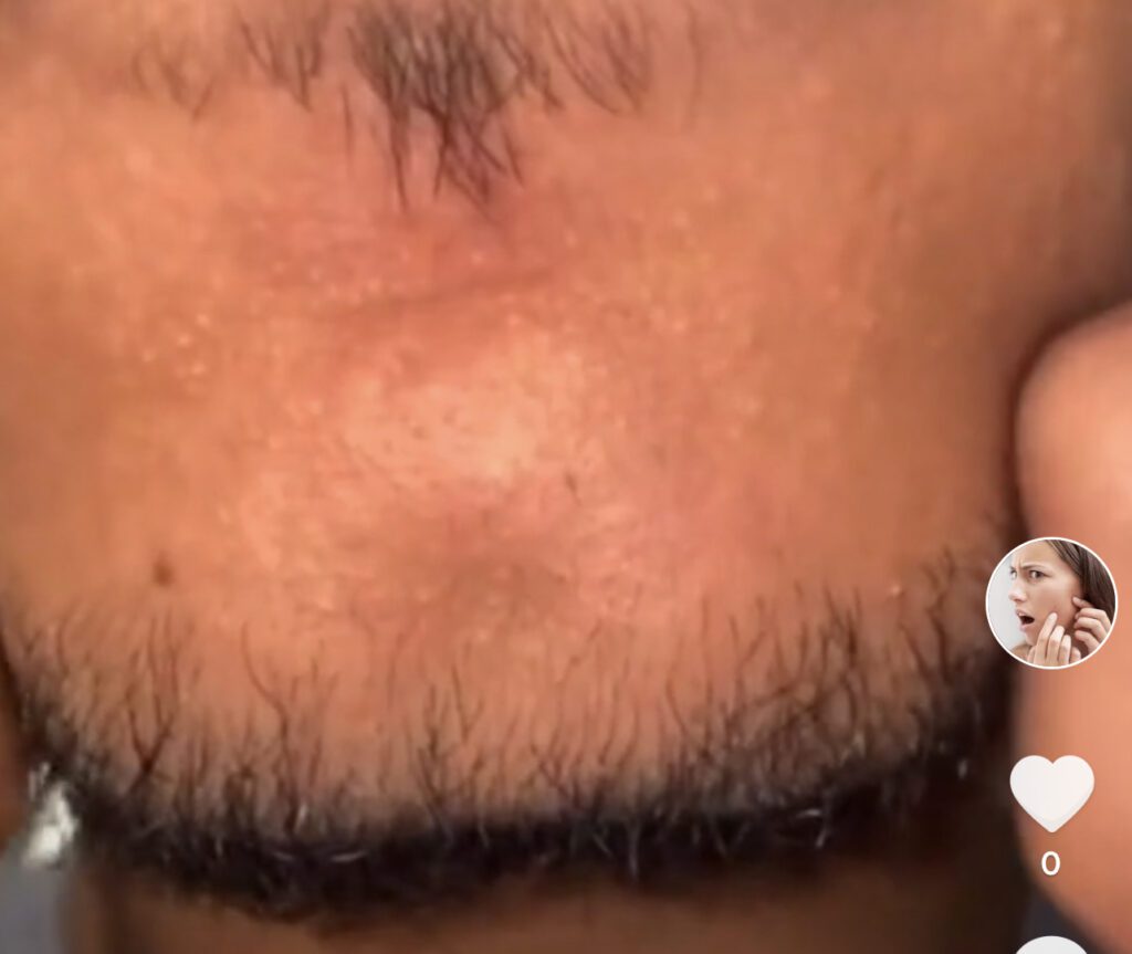 Chin Cheese 1