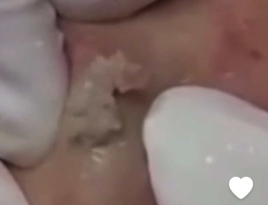 The Longest Cyst Squeeze 1