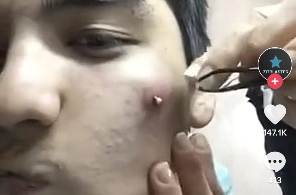 Blackhead Pull 1