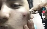 Blackhead Pull 3 Blackhead Pull 3