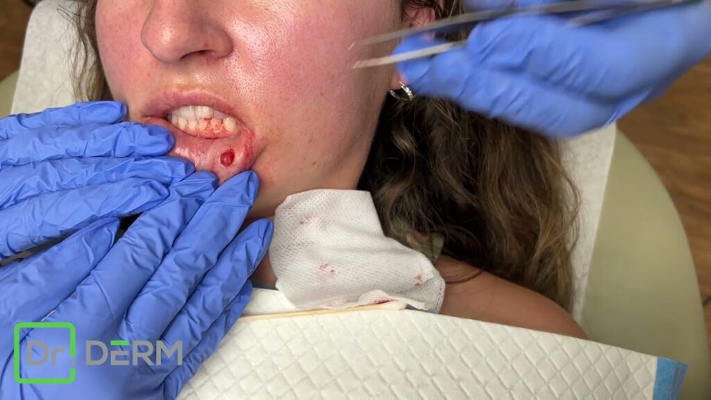 Blocked Salivary Gland 1