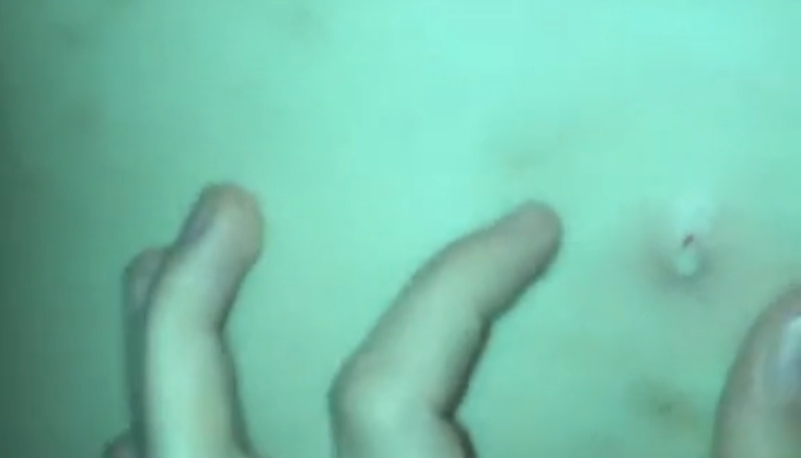 Cyst Pop - You forgot the sac! 1