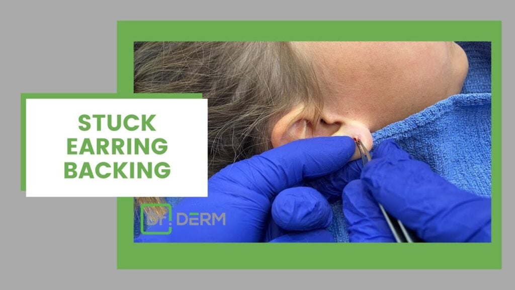 Earring back removal - Dr Derm 1