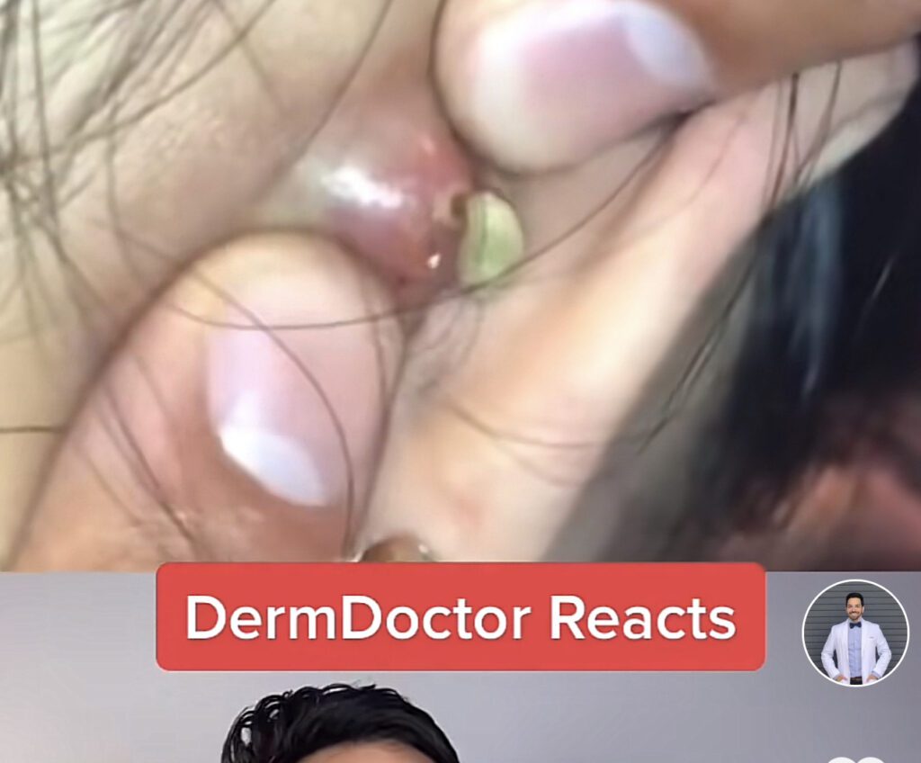 Infected Abscess - Doctor Reaction 1
