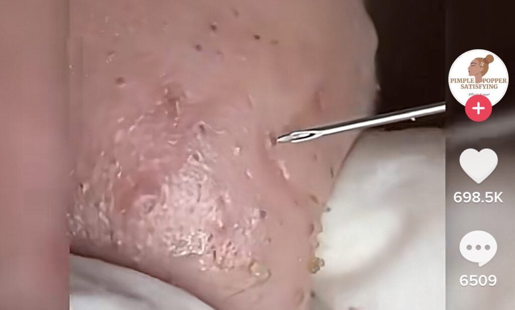 Little Nose Blackheads 1