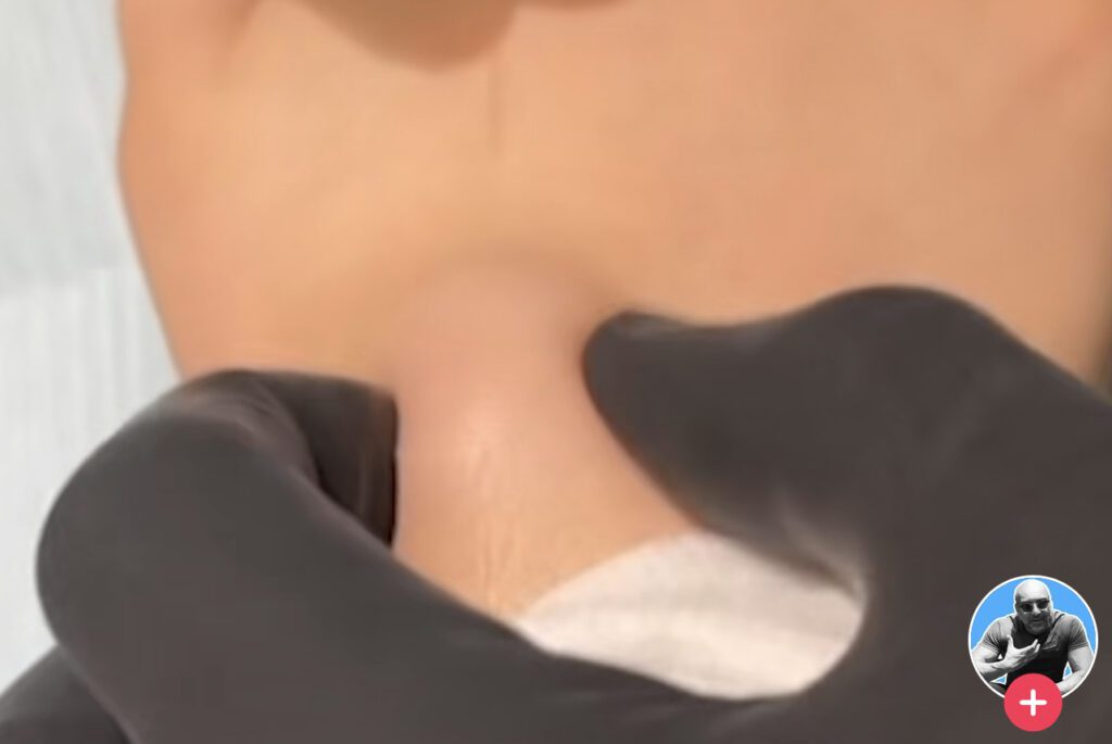 Ganglion cyst 1