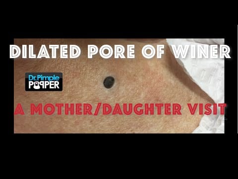 Dilated Pore of Winer 1