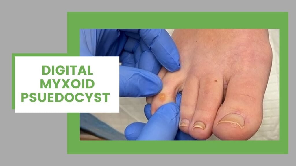 Toe Cyst 1
